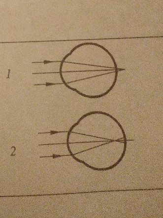 Какая из схем хода лучей в глазу человека соответствует случаю близорукости глаза